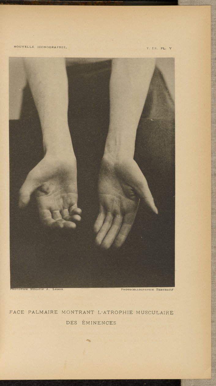 Palmar Face Showing Muscular Atrophy of the Eminences by Albert Londe