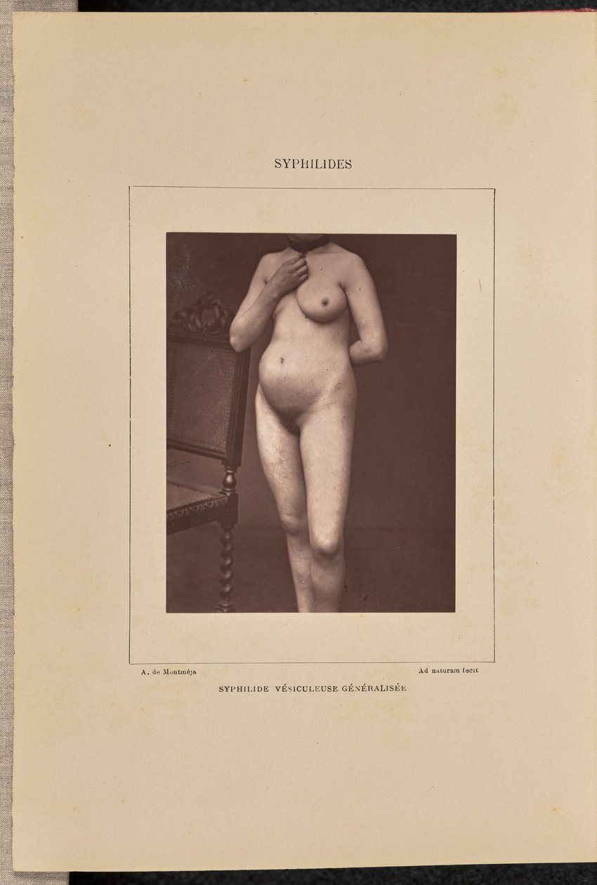 Generalized Vesicular Syphilis by Arthur de Montmeja