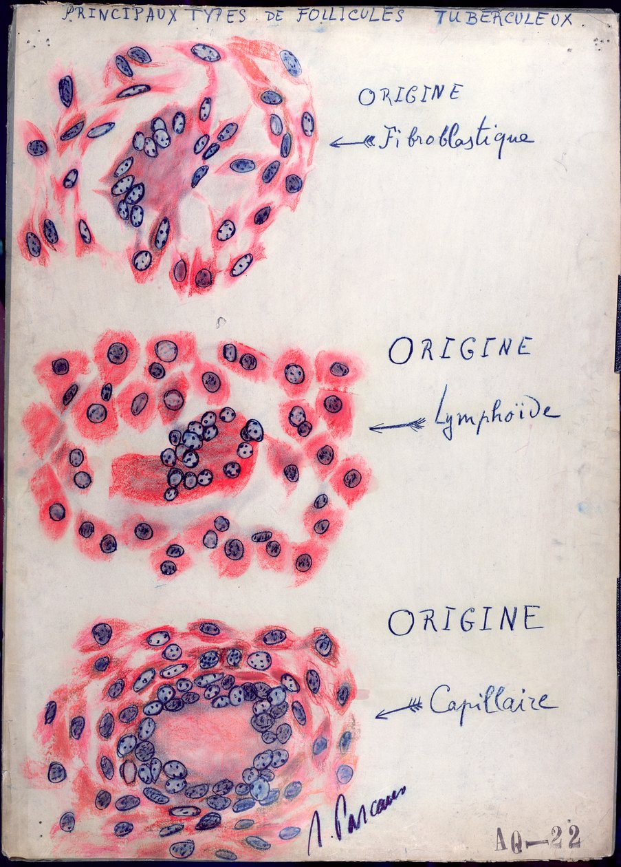 Principle tuberculosis follicles by French School
