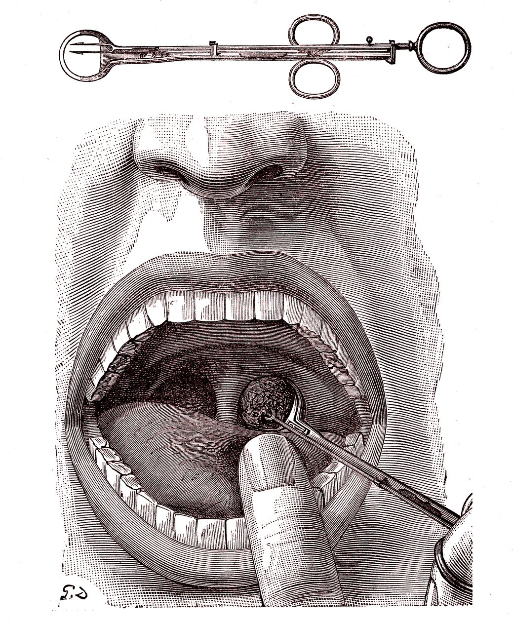Tonsillectomy by French School