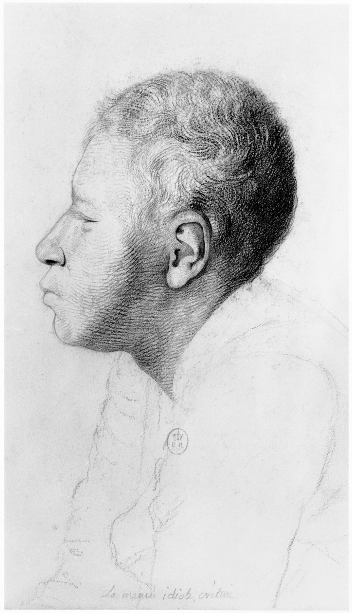 Cretin, profile, illustration from an unpublished treatise by Jean Etienne Dominique Esquirol on the lunatics of the Salpetriere asylum by Georges Francois Gabriel