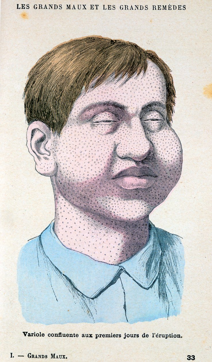 Smallpox Victim, c1890 by Unbekannt