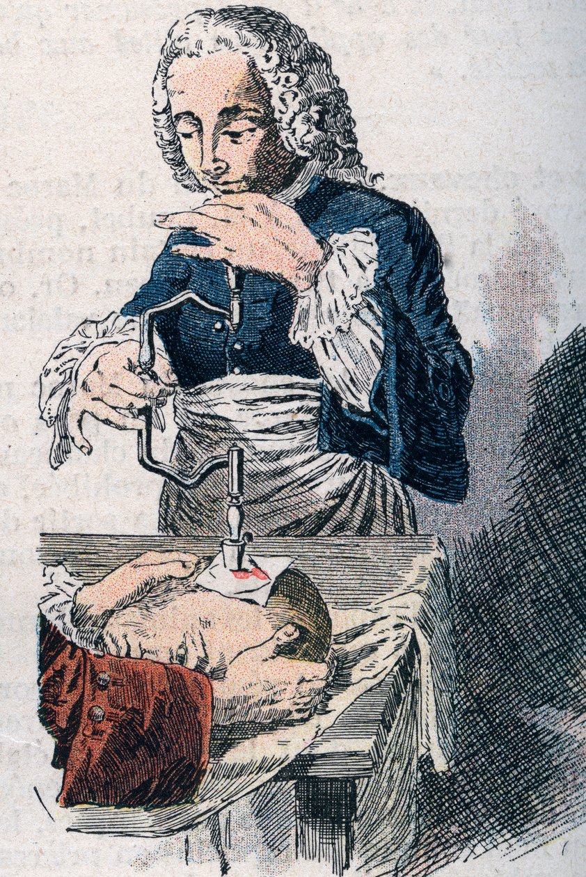The Trepanation. 18th century print. by Unknown artist
