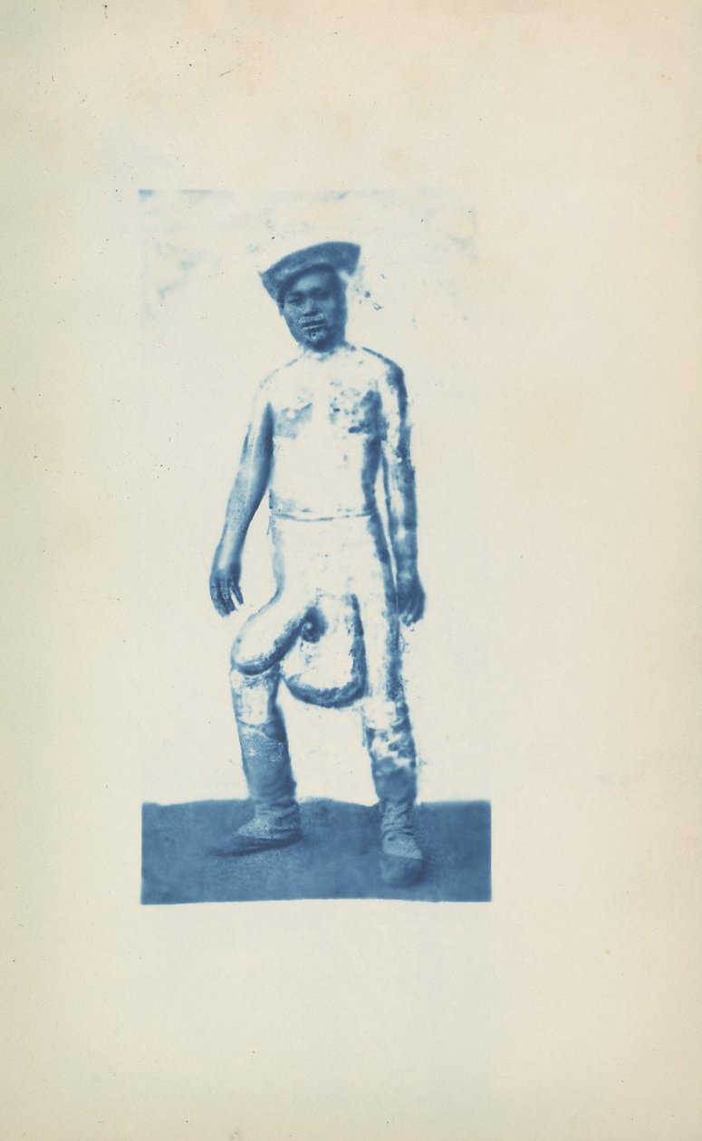Elephantiasis, c. 1870s by Unknown photographer