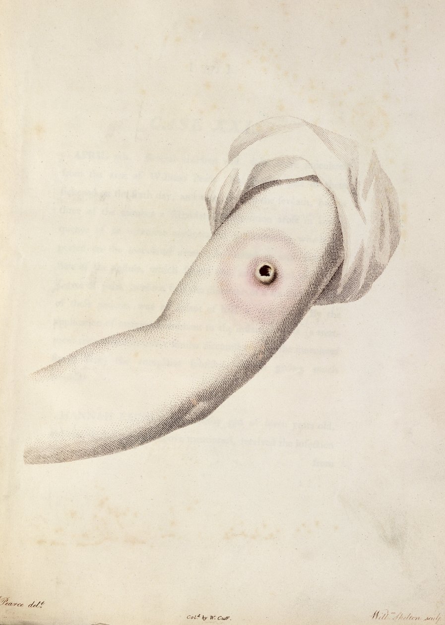 Cowpox Pustule on an Arm, from 