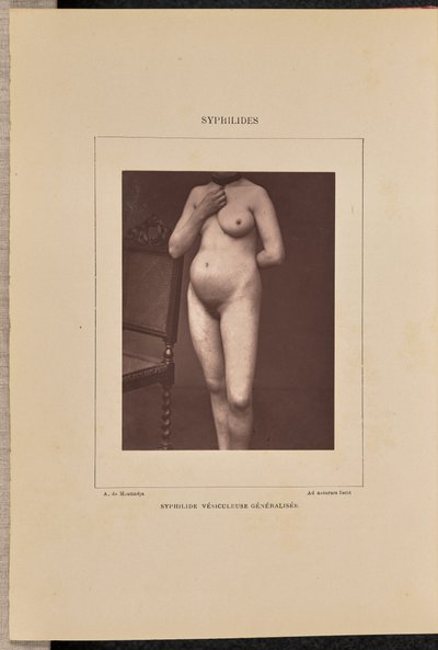 Generalized Vesicular Syphilis by Arthur de Montmeja