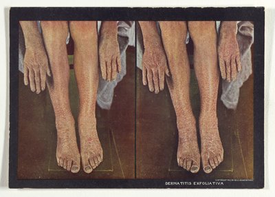 Exfoliative Dermatitis by Dr. Selden I. Rainforth