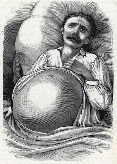 Patient with advanced liver cirrhosis (engraving) 1888 by French School