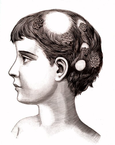 Ringworm on child (engraving) by French School