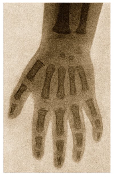 X Ray of a Child