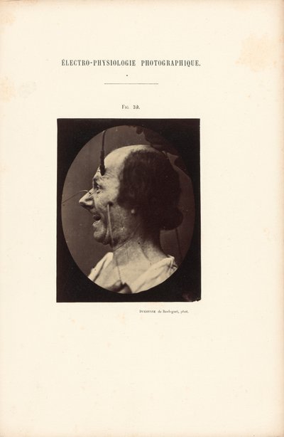 Electro-Physiology Photographic, Figure 39 by Guillaume Benjamin Duchenne