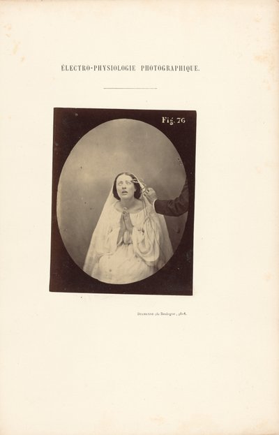 Electro-Physiology Photographic, Figure 76 by Guillaume Benjamin Duchenne