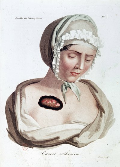 Anthracine Cancer by Jean Louis Alibert
