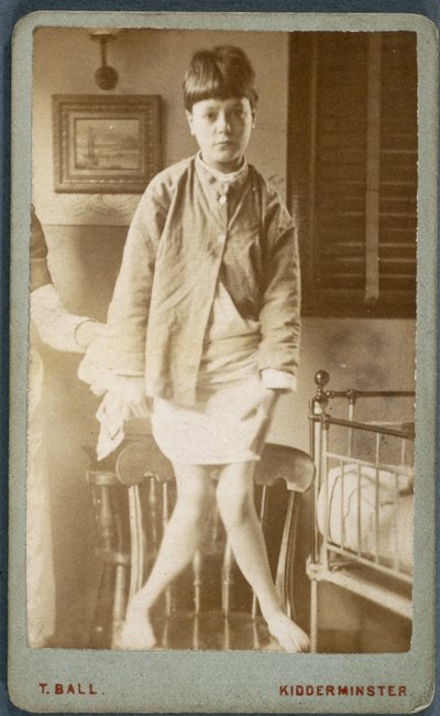 Diseases, Rickets Child with rickets by Unbekannt