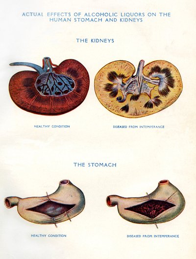 Kidneys and stomach affected by alcohol by Unbekannt