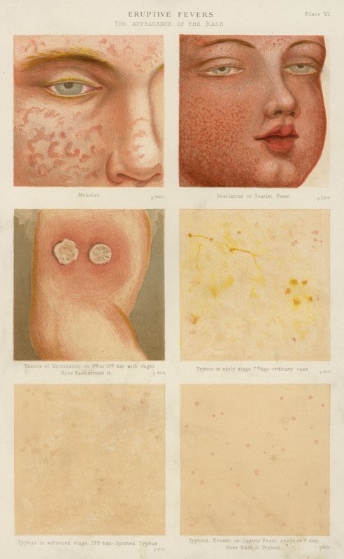 Eruptive Fevers by English School