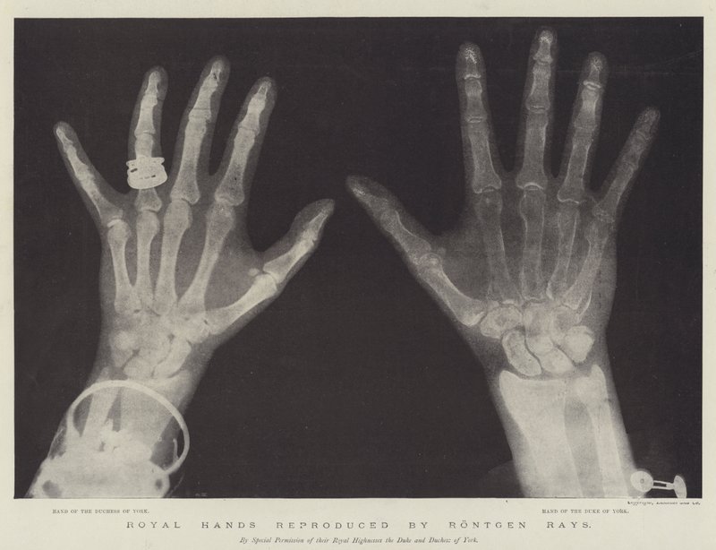 Royal Hands reproduced by Rontgen Rays by English School
