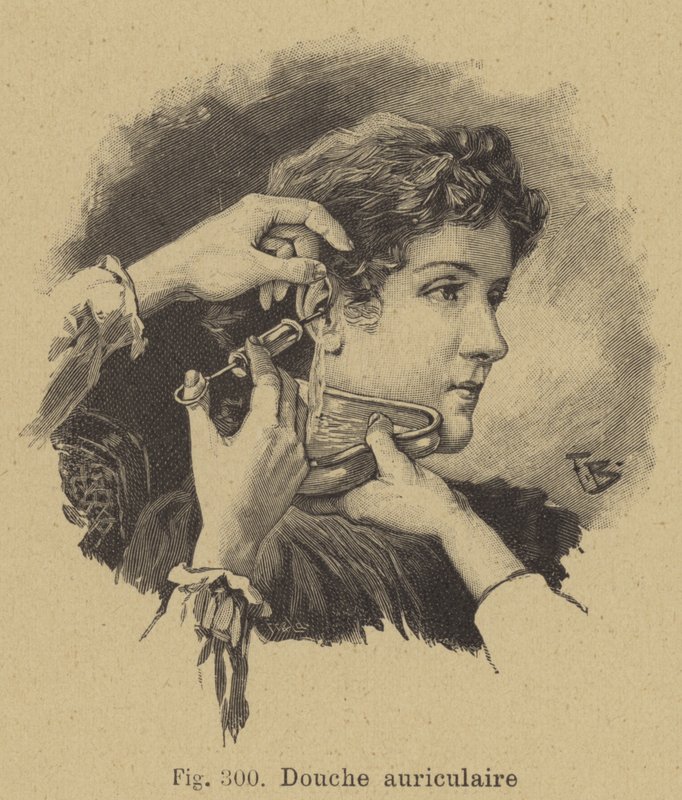 Ear Irrigation by German School